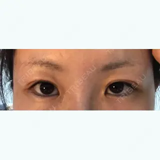 12日目の経過画像（1枚目）