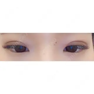 6日目の経過画像（2枚目）