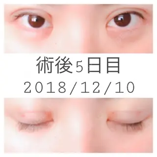 5日目の経過画像（1枚目）