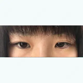 15日目の経過画像（2枚目）