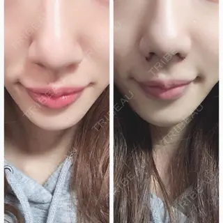 3日目の経過画像（1枚目）
