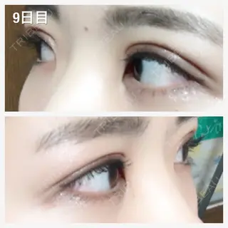 9日目の経過画像（2枚目）