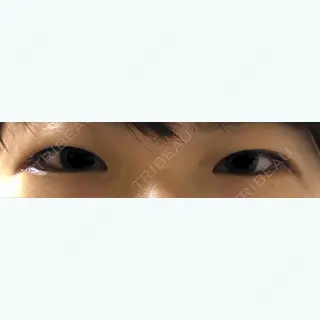 5日目の経過画像（1枚目）