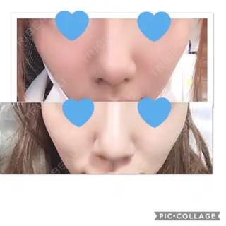 4日目の経過画像（3枚目）