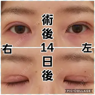 14日目の経過画像（1枚目）