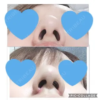 5日目の経過画像（2枚目）