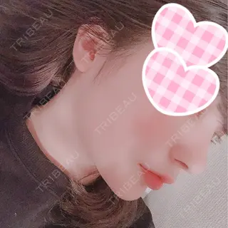 15日目の経過画像（2枚目）