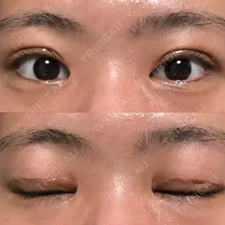 12日目の経過画像（1枚目）