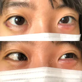 3日目の経過画像（1枚目）
