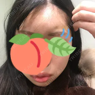 4日目の経過画像（1枚目）