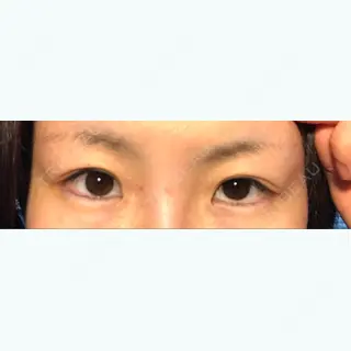 51日目の経過画像（1枚目）
