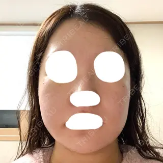 5日目の経過画像（1枚目）