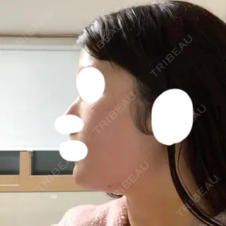 5日目の経過画像（2枚目）