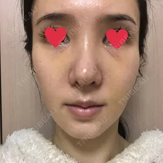 8日目の経過画像（1枚目）