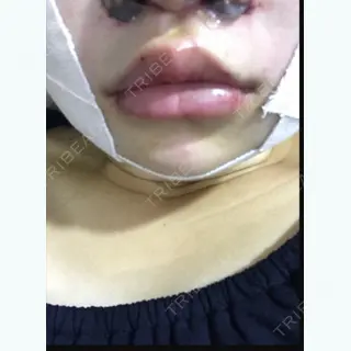 0日目の経過画像（2枚目）