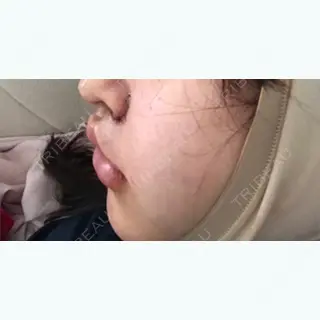 1日目の経過画像（2枚目）