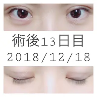 13日目の経過画像（1枚目）