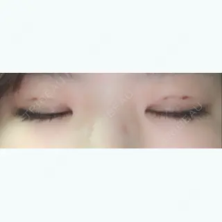 0日目の経過画像（2枚目）