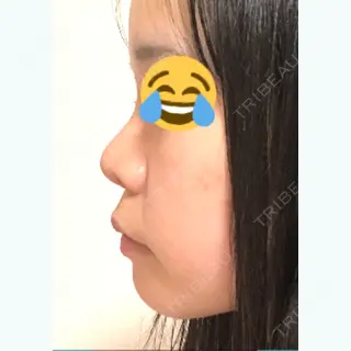 166日目の経過画像（1枚目）