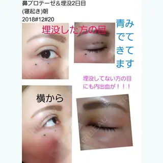 2日目の経過画像（1枚目）