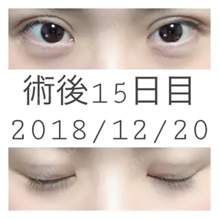 15日目の経過画像（1枚目）