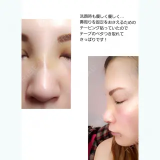 3日目の経過画像（1枚目）