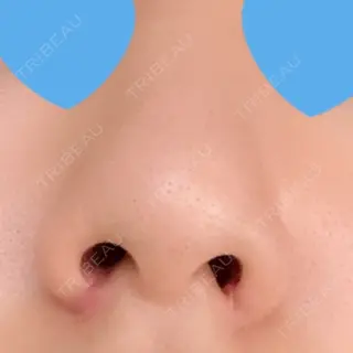12日目の経過画像（2枚目）