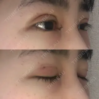 2日目の経過画像（2枚目）
