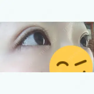 19日目の経過画像（3枚目）