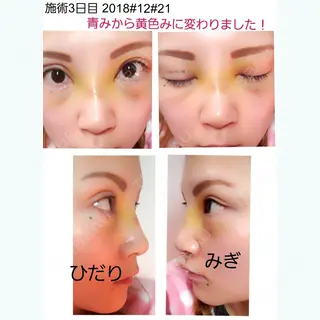 3日目の経過画像（1枚目）