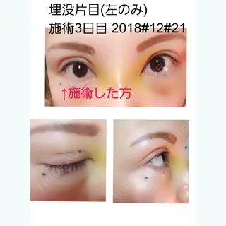 3日目の経過画像（1枚目）