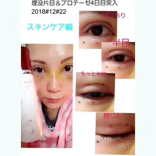 4日目の経過画像（1枚目）