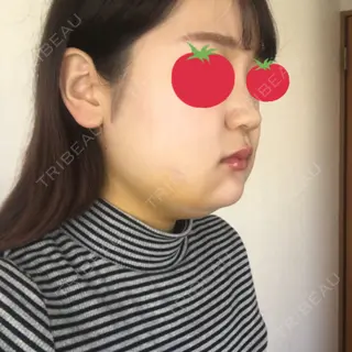 6日目の経過画像（2枚目）