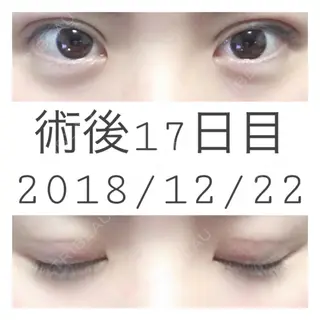 17日目の経過画像（1枚目）