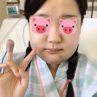 3日目の経過画像（1枚目）