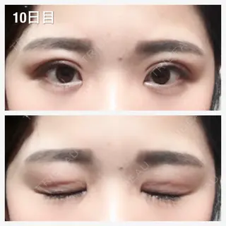 10日目の経過画像（1枚目）
