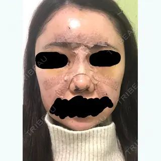 4日目の経過画像（3枚目）