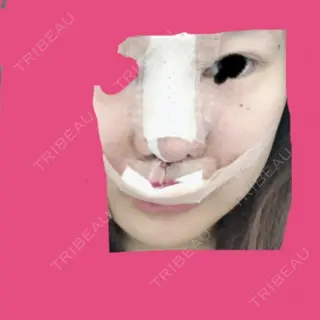 1日目の経過画像（1枚目）