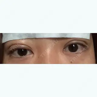 1日目の経過画像（2枚目）
