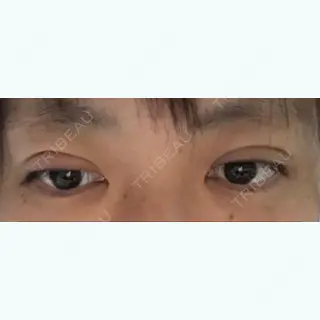 1日目の経過画像（3枚目）