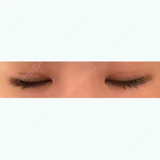 4日目の経過画像（2枚目）