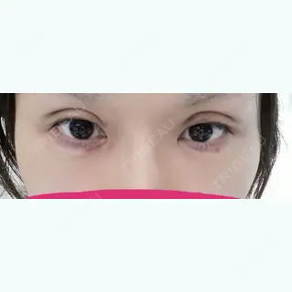 2日目の経過画像（1枚目）