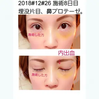 8日目の経過画像（1枚目）