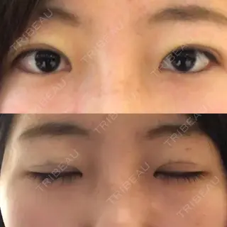 0日目の経過画像（1枚目）
