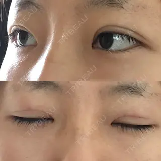 1日目の経過画像（2枚目）