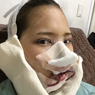 0日目の経過画像（2枚目）
