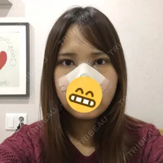 4日目の経過画像（1枚目）