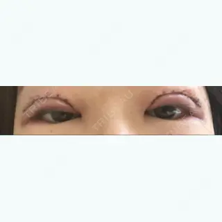 0日目の経過画像（2枚目）