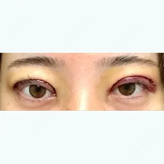 0日目の経過画像（1枚目）