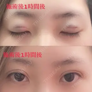 0日目の経過画像（1枚目）